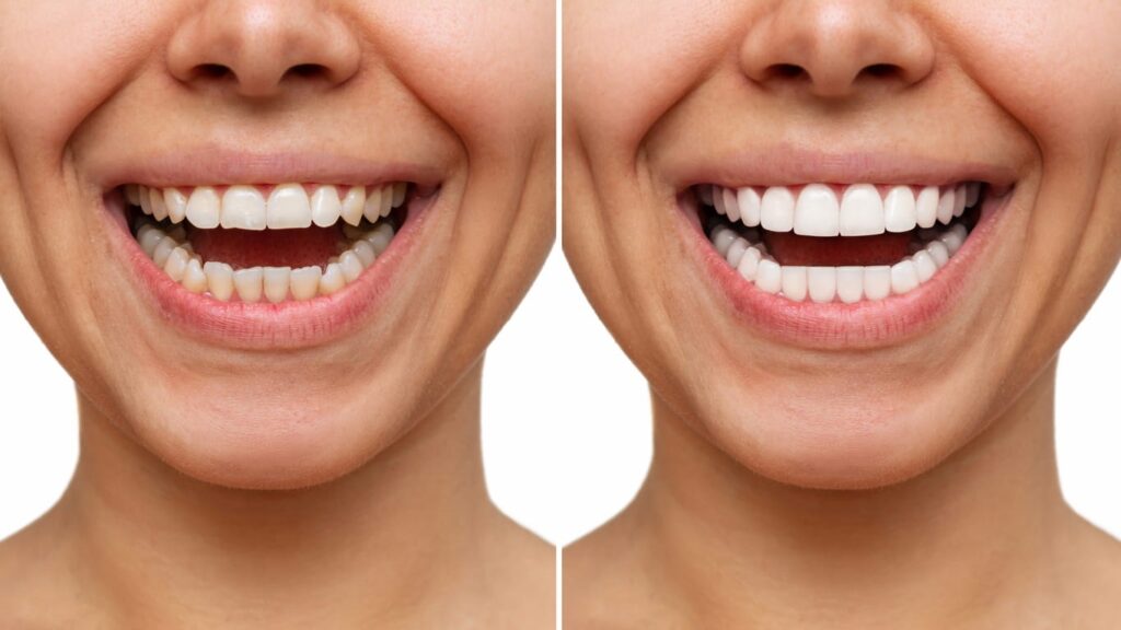 Dental Bonding Before and After